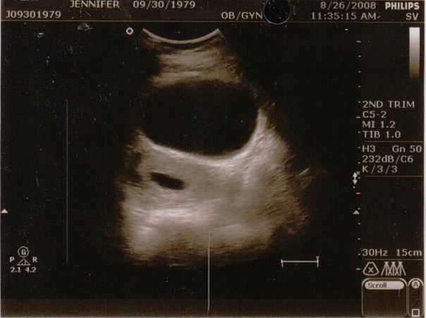 2008-08-26 Blighted Ovum PD_0170a