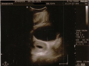 2008-08-26 Blighted Ovum PD_0170b