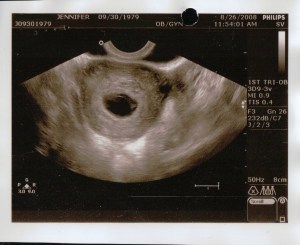 2008-08-26 Blighted Ovum PD_0172