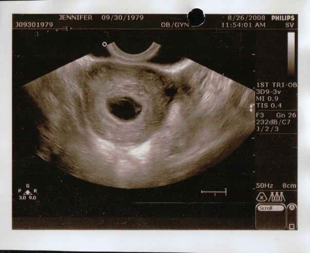 2008-08-26 Blighted Ovum PD_0172